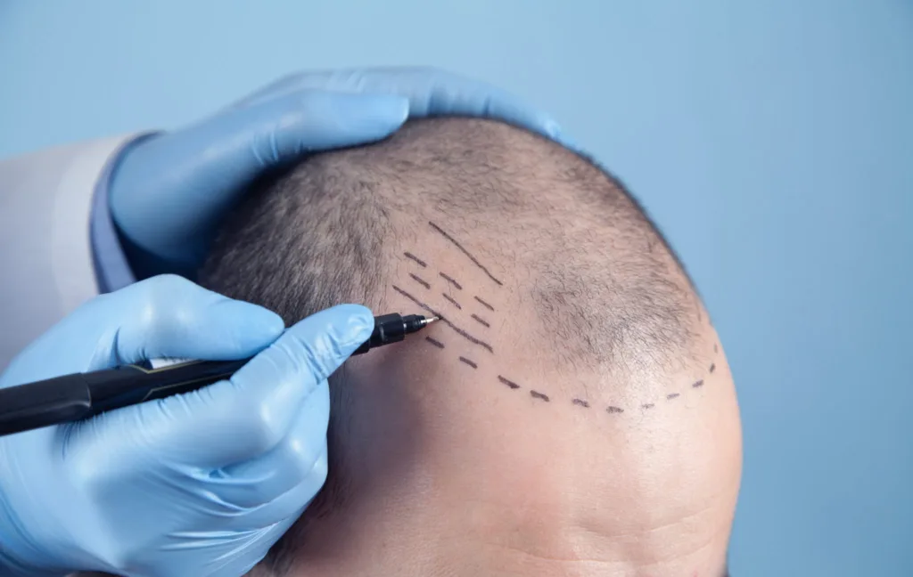 hair transplant in london