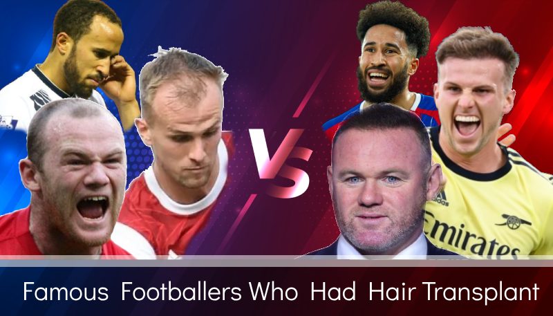 famous footballers hair transplant